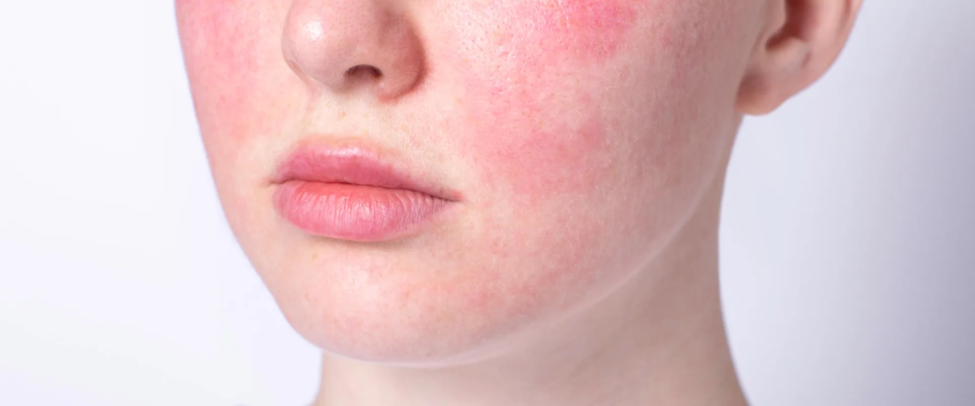 rash on face. histamine and IBS. IBS dietitian in California and Europe